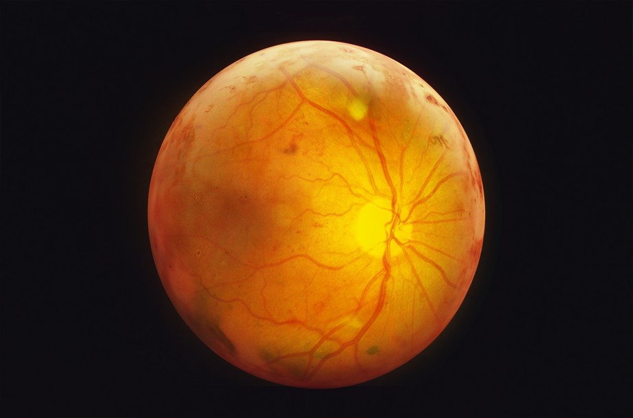 Metabonomics reveals biomarkers of diabetic retinopathy in blood