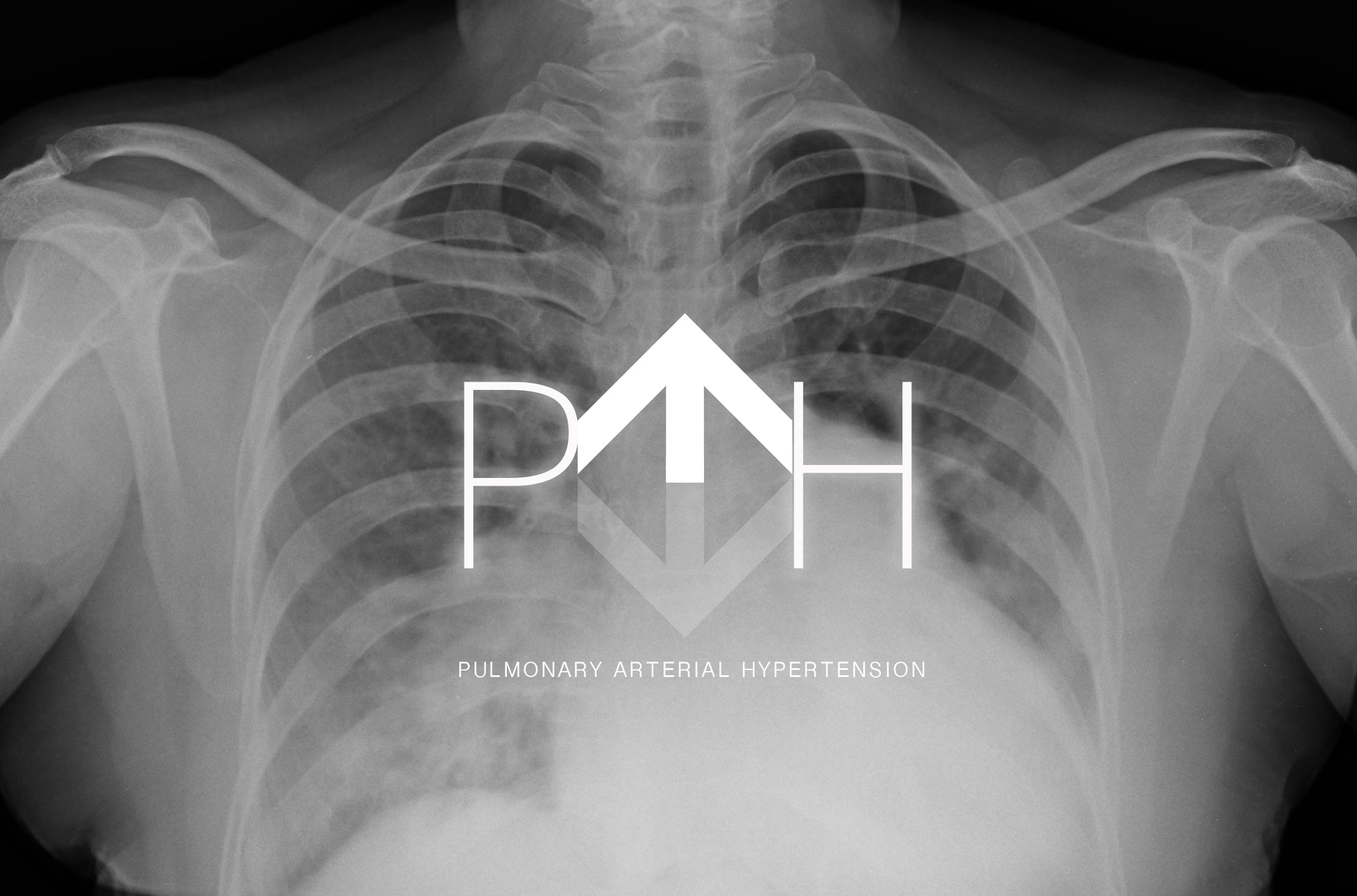 Breathing in treatment for pulmonary arterial hypertension (PAH)