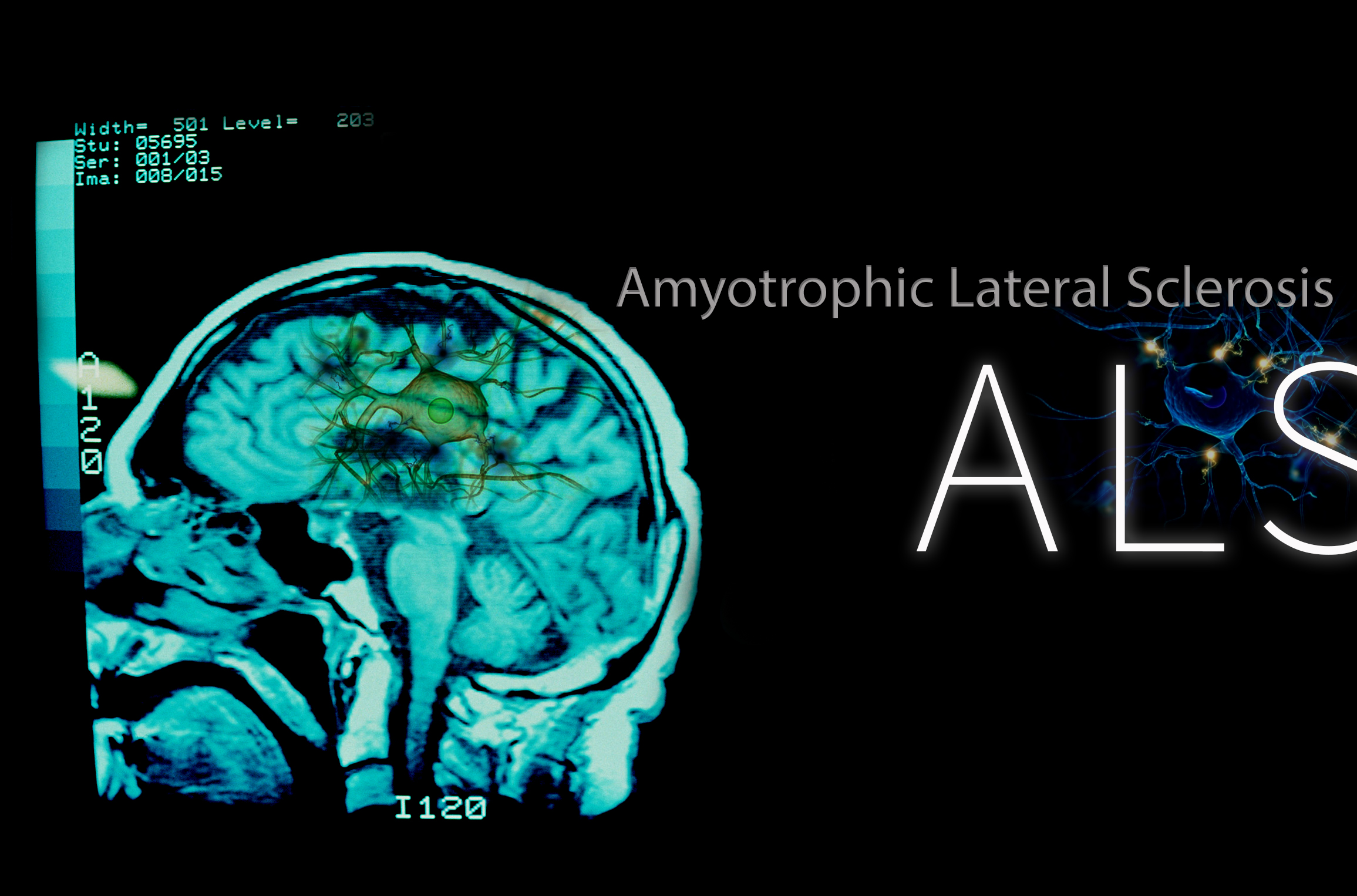 Amyotrophic lateral sclerosis (ALS) mediated by protein dynamics and interaction with membranes