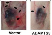 Increasing ADAMTS5 Protein Production May Control Cancer Progression