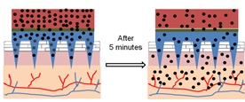 Microneedles for pain killers